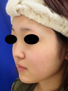 ②術前　左斜位